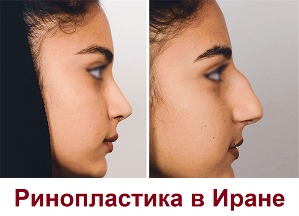 Сколько стоит ринопластика в Иране